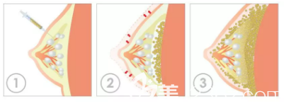 自體脂肪豐胸的流程圖