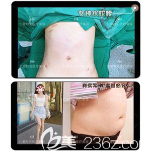 魏軼群院長吸脂瘦腰腹術(shù)后小蠻腰盡顯