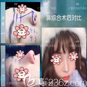 包院長做鼻綜合術(shù)前術(shù)后對比圖
