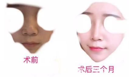 耳軟骨隆鼻案例