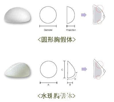 曼托胸假體圓形與水滴形比較 曼托胸假體圓形與水滴形比較