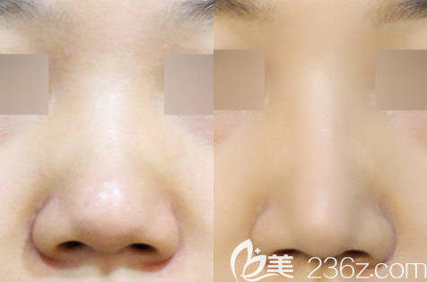 在長春姬安娣整形做自體軟骨隆鼻修復(fù)的前后效果圖 在長春姬安娣整形做自體軟骨隆鼻修復(fù)的前后效果圖