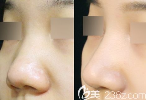 去年做假體隆鼻失敗了,還好長春姬安娣整形的自體軟骨隆鼻修復(fù)使我擁有挺翹美鼻！