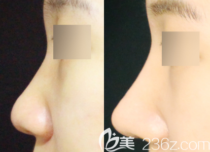 長春姬安娣整形修復(fù)假體隆鼻失敗案例效果對比圖 長春姬安娣整形修復(fù)假體隆鼻失敗案例效果對比圖