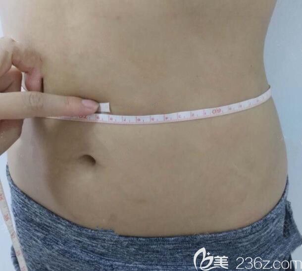 我在桂林華美整形做腰腹部吸脂前的照片 我在桂林華美整形做腰腹部吸脂前的照片