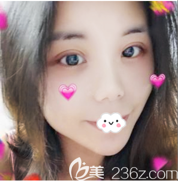 面診感覺中山美南華整形醫(yī)院挺正規(guī)的就找院長做了全切雙眼皮