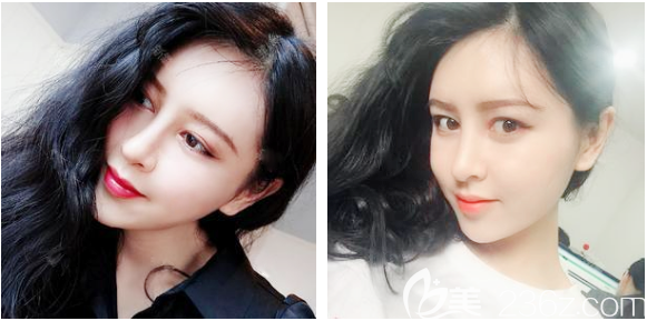 東莞脂肪填充哪家好？參考我找東莞壹加壹王擎院長(zhǎng)做的全臉脂肪填充恢復(fù)期照片吧