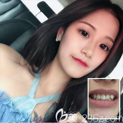 東莞壹加壹口腔醫(yī)院隱形牙齒矯正案例