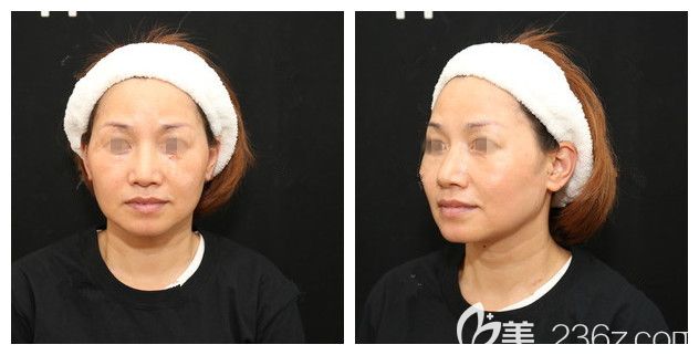 面診南京華韓奇致術(shù)前面部衰老明顯 面診南京華韓奇致術(shù)前面部衰老明顯