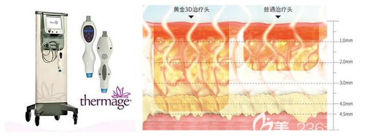 第四代塑美極儀器及原理 第四代塑美極儀器及原理