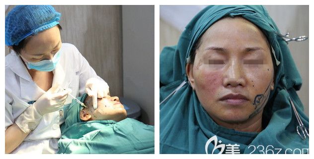 體驗熱瑪吉治療過程中 體驗熱瑪吉治療過程中