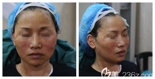 剛做完熱瑪吉第四代面部紅腫 剛做完熱瑪吉第四代面部紅腫