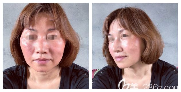 熱瑪吉術(shù)后第二天效果紅腫淡化 熱瑪吉術(shù)后第二天效果紅腫淡化