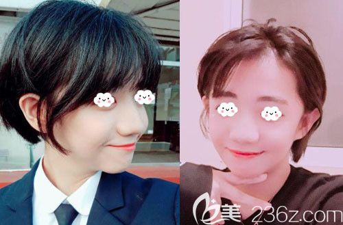 突嘴矯正帶牙套沒有用，找韓國EU頜面輪廓整形外科金鐘潤做上下顎突出矯正手術(shù)后案例圖