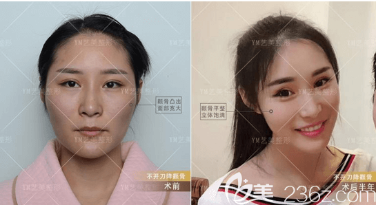 北京藝美王東醫(yī)生降顴骨案例