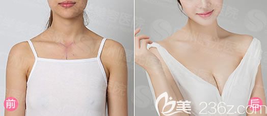 曼托假體260cc大小隆胸案例效果圖