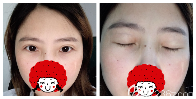 原本內(nèi)雙眼因皮膚松弛變單眼皮 找蘇州紫馨孫影做了割雙眼皮+去皮眼綜合后get到媽生原裝8mm雙眼皮效果
