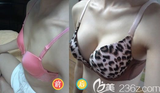 麥格260cc水滴形假體隆胸案例效果圖