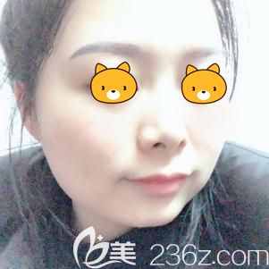 盛醫(yī)生幫我做激光祛斑術(shù)后7天斑點(diǎn)消失 盛醫(yī)生幫我做激光祛斑術(shù)后7天斑點(diǎn)消失