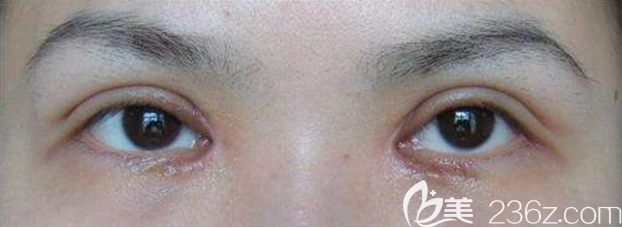 雙眼皮手術(shù)失敗圖片 雙眼皮手術(shù)失敗圖片