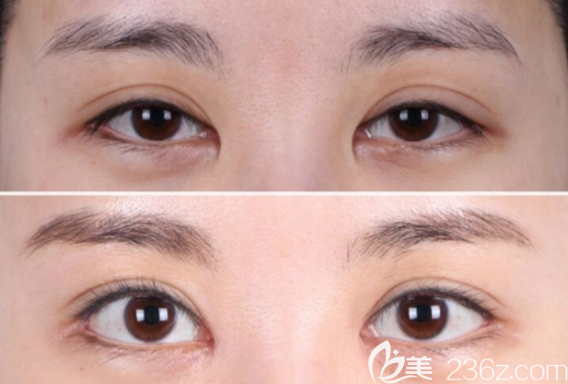 雙眼皮矯正手術(shù)前后對比照片 雙眼皮矯正手術(shù)前后對比照片