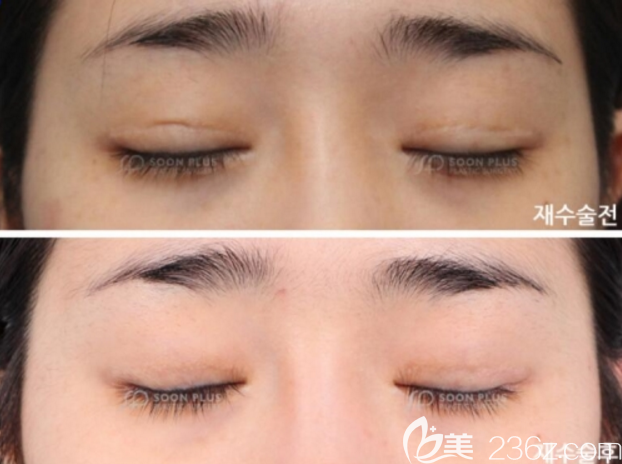 雙眼皮疤痕增生圖片與修復效果 雙眼皮疤痕增生圖片與修復效果