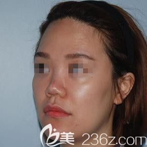 在張家口天宏做脂肪填充+鼻綜合術(shù)前是凹陷臉和塌鼻子 在張家口天宏做脂肪填充+鼻綜合術(shù)前是凹陷臉和塌鼻子