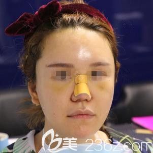 <!--<i data=20240703-sp></i>-->東醫(yī)生為我做脂肪填充和鼻綜合術(shù)后面部腫脹 <!--<i data=20240703-sp></i>-->東醫(yī)生為我做脂肪填充和鼻綜合術(shù)后面部腫脹