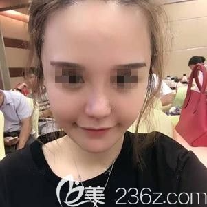 在張家口天宏做脂肪填充+鼻綜合術(shù)后10天慢慢恢復(fù)中 在張家口天宏做脂肪填充+鼻綜合術(shù)后10天慢慢恢復(fù)中