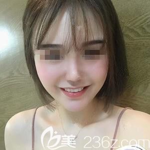 <!--<i data=20240703-sp></i>-->東醫(yī)生為我做脂肪填充和鼻綜合術(shù)后28天慢慢消腫 <!--<i data=20240703-sp></i>-->東醫(yī)生為我做脂肪填充和鼻綜合術(shù)后28天慢慢消腫