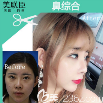 楊輝醫(yī)生隆鼻案例