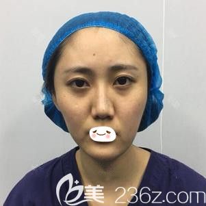 在石家莊天宏做脂肪填充術前是凹陷臉 在石家莊天宏做脂肪填充術前是凹陷臉