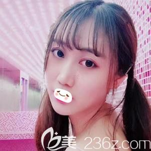 張學雷醫(yī)生為我做脂肪填充面部術后5天面部飽滿 張學雷醫(yī)生為我做脂肪填充面部術后5天面部飽滿