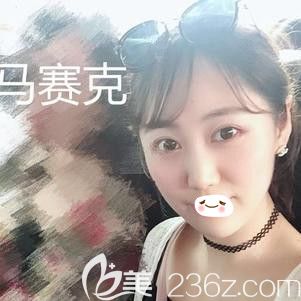 張學雷醫(yī)生為我做面部自體脂肪填充術后1個月脂肪基本穩(wěn)定 張學雷醫(yī)生為我做面部自體脂肪填充術后1個月脂肪基本穩(wěn)定