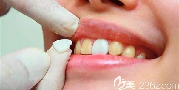 做完牙齒貼面后不會掉色 做完牙齒貼面后不會掉色