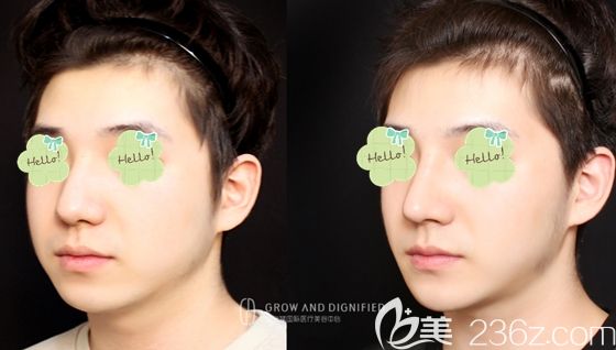 長春姬安娣整形駝峰鼻矯正和下巴整形前后對比效果 長春姬安娣整形駝峰鼻矯正和下巴整形前后對比效果