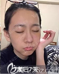 選擇北京祛眼袋好的醫(yī)院北京藝星做了無痕內(nèi)切祛眼袋第7天樣子 選擇北京祛眼袋好的醫(yī)院北京藝星做了無痕內(nèi)切祛眼袋第7天樣子