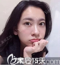 我在北京藝星醫(yī)院做無痕內(nèi)切祛眼袋半個月效果 我在北京藝星醫(yī)院做無痕內(nèi)切祛眼袋半個月效果