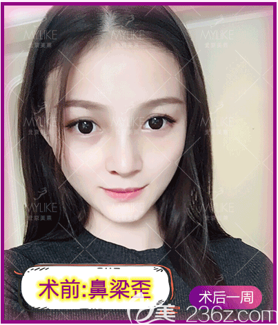 <!--<i data=20240703-sp></i>-->醫(yī)生給我做鼻梁歪矯正手術(shù)第7天效果 <!--<i data=20240703-sp></i>-->醫(yī)生給我做鼻梁歪矯正手術(shù)第7天效果