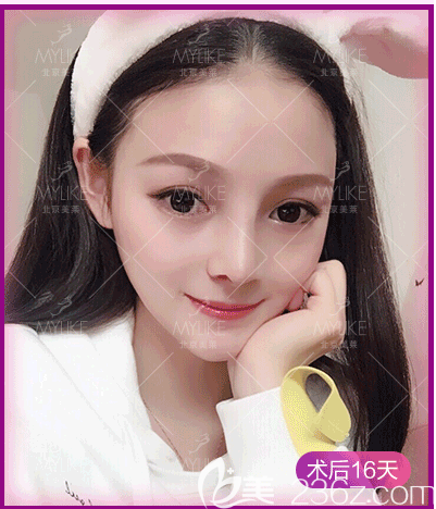 我找北京做歪鼻矯正還好的<!--<i data=20240703-sp></i>-->醫(yī)生做歪鼻矯正第16天效果 我找北京做歪鼻矯正還好的<!--<i data=20240703-sp></i>-->醫(yī)生做歪鼻矯正第16天效果