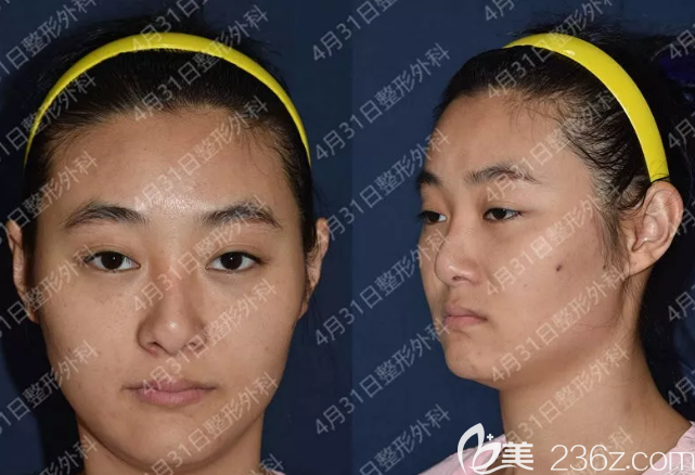 韓國4月31日整形雙眼皮+鼻綜合隆鼻+自體脂肪填充全臉案例 韓國4月31日整形雙眼皮+鼻綜合隆鼻+自體脂肪填充全臉案例
