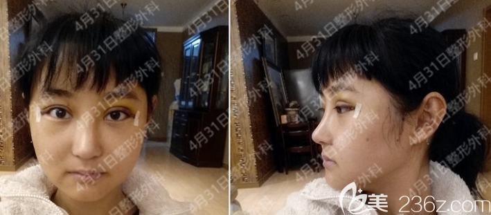 韓國4月31日金載勛隆鼻+自體脂肪填充術(shù)后2周 韓國4月31日金載勛隆鼻+自體脂肪填充術(shù)后2周