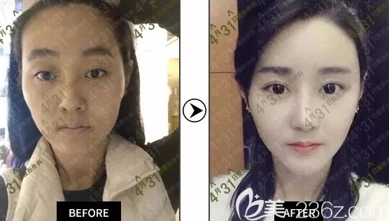 去韓國4月31日整形術(shù)前術(shù)后真實(shí)效果對(duì)比圖 去韓國4月31日整形術(shù)前術(shù)后真實(shí)效果對(duì)比圖