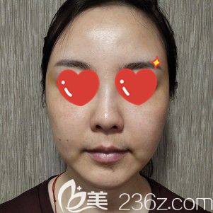 到武漢美基元面診前法令紋木偶紋明顯的自己 到武漢美基元面診前法令紋木偶紋明顯的自己