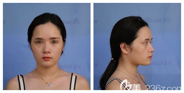 注射過幾次玻尿酸隆鼻山根變寬 注射過幾次玻尿酸隆鼻山根變寬