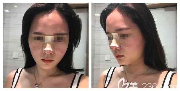 耳軟骨墊鼻尖+艷冠假體鼻修復(fù)術(shù)后三天恢復(fù)情況 耳軟骨墊鼻尖+艷冠假體鼻修復(fù)術(shù)后三天恢復(fù)情況