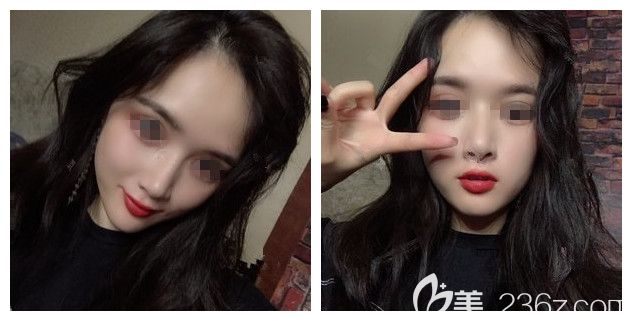 拆線后耳軟骨墊鼻尖+艷冠假體鼻修復(fù)恢復(fù) 拆線后耳軟骨墊鼻尖+艷冠假體鼻修復(fù)恢復(fù)