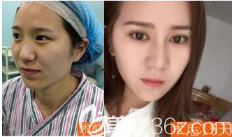 萊山京韓醫(yī)療美容診所雙眼皮案例