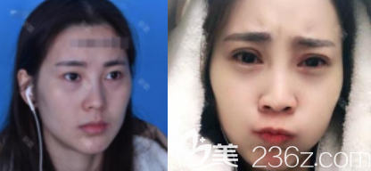 煙臺壹美雙眼皮案例