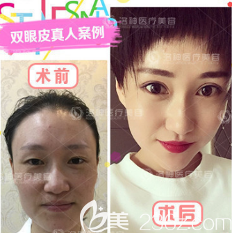 煙臺洛神雙眼皮案例